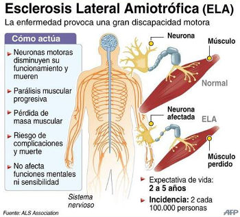 Esclerosis Lateral Amiotrófica